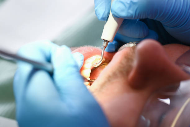 Best Emergency Treatment for Dental Infections or Abscesses in Knoxville, TN